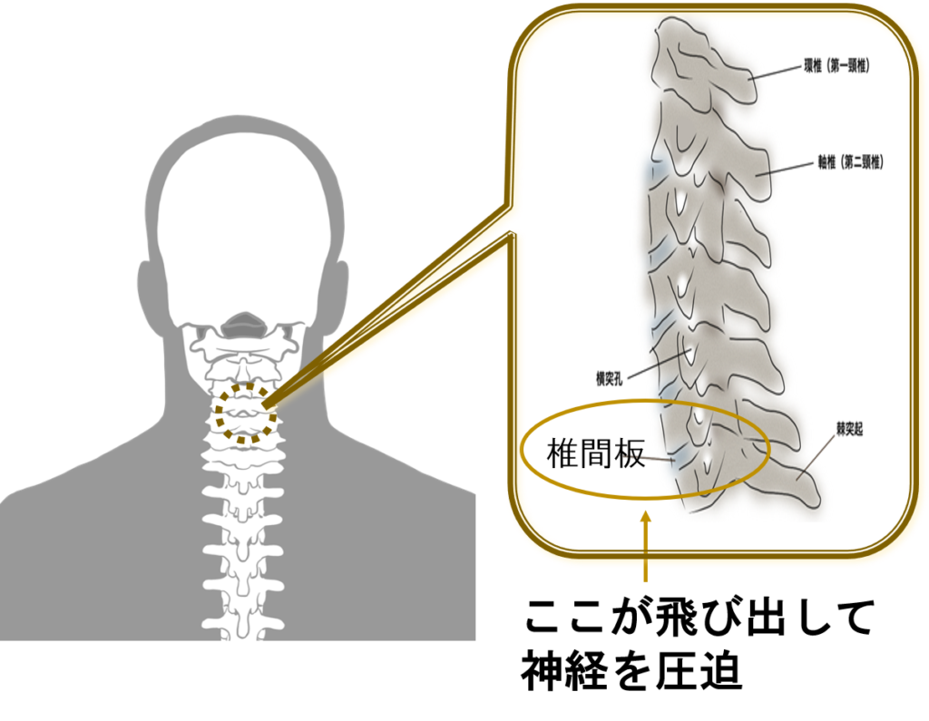 頚椎椎間板ヘルニアの図
