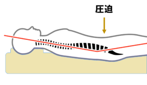 寝姿勢での股関節部分の圧迫