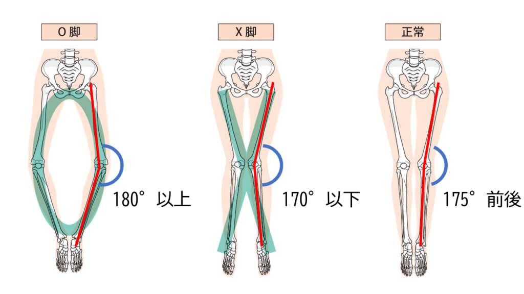 O脚やX脚の指標の図