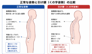 正常な姿勢とくの字姿勢の腰椎のカーブの比較