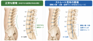 正常な腰椎とストレート腰椎の状態の違い