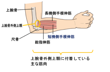 腕（前腕）が痛くなるのは何故？