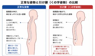 正常な姿勢とくの字姿勢の腰椎のカーブの比較