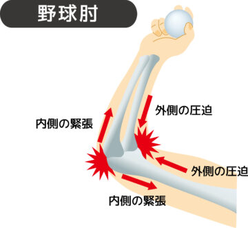 慢性化しやすい肘や腕の症状