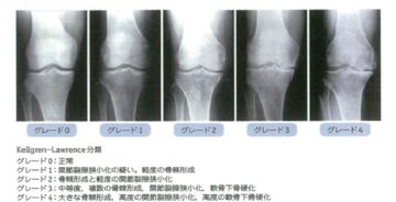 変形性膝関節症の症状と診断基準