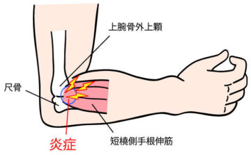 慢性化しやすい肘や腕の症状
