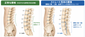 正常な腰椎とストレート腰椎の状態の違い