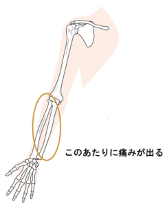 ふとした瞬間に腕が痛い