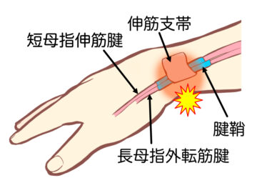 慢性化しやすい肘や腕の症状
